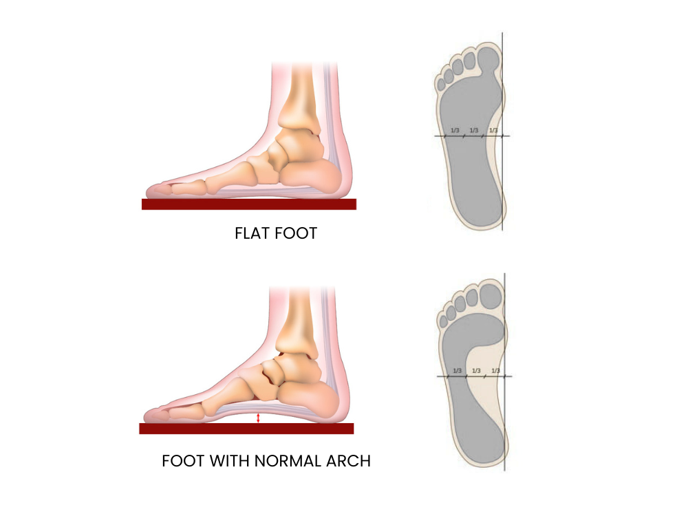 Types of Feet Based on Arch Shape socks for FLAT FOOT padded cushion socks for foot pain men and women